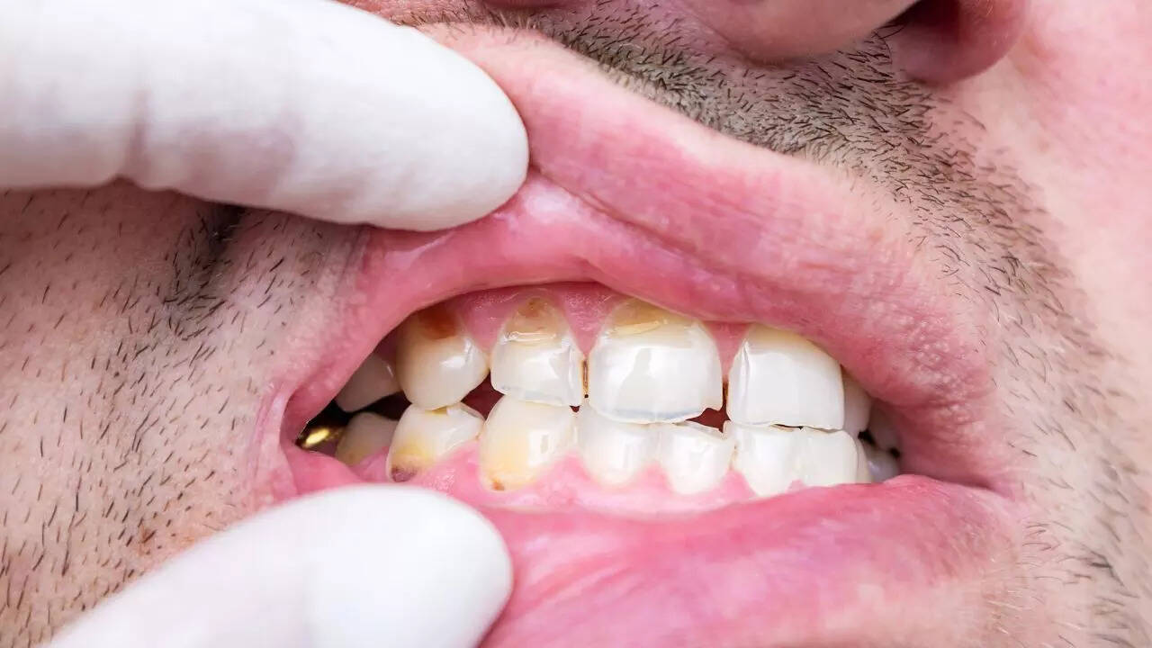 Chipped or cracked teeth: A sign of teeth grinding (Bruxism)